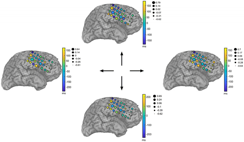  В одном из экспериментов по расшифровке MRCP оператору с ЭЭГ-шлемом (который, впрочем, чаще называют «чепчиком») на голове предлагалось с помощью обычного джойстика перемещать точку на экране компьютера вверх, вниз, вправо или влево. На приведённой диаграмме показано, как в управляющем движениями кисти отделе мозга меняются замеряемые потенциалы на отдельных участках в зависимости то того, в каком направлении оператор двигает джойстик (источник: Universidad San Francisco de Quito) 