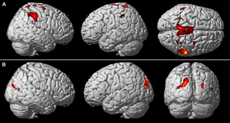  Для изучение того, какие участки мозга активируются в процессе физической деятельности, приходится прибегать к симуляциям. В данном случае под ногами оператора fMRT был размещён перпендикулярный лежанке крупный валик, перемещение ступней по которому имитировало ходьбу, а на экран перед глазами выводились различные виртуальные виды окружающей обстановки. В данном случае серия проекций А показывает, какие участки мозга активизируются в ходе прогулки по открытой местности, серия B — при движении по узкому коридору (источник: Università Magna Graecia) 