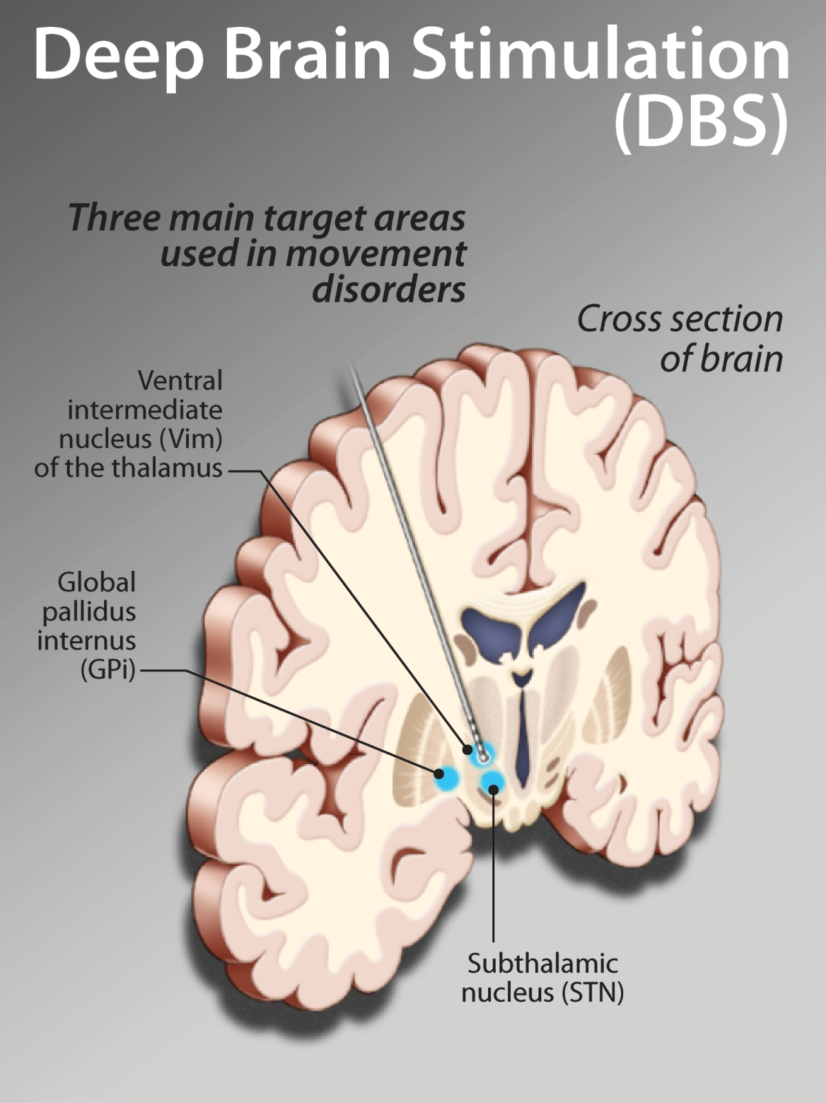 Deep brain. Глубокая стимуляция мозга. Глубокая стимуляция мозга DBS. Deep Brain stimulation глубинная стимуляция мозга. DBS стимулятор Паркинсона.