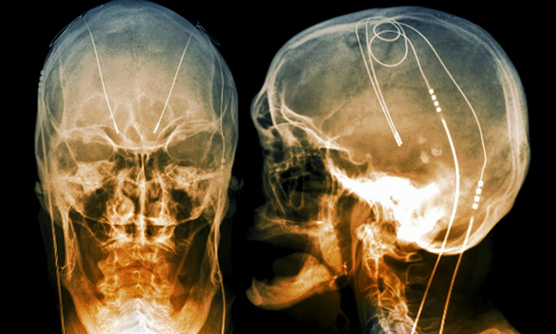  Электроды для глубокой стимуляции мозга, вживлённые в голову пациента с болезнью Паркинсона, своего рода «мозговой (по аналогии с сердечным) водитель ритма»: колоризованная рентгенограмма (источник: Science) 
