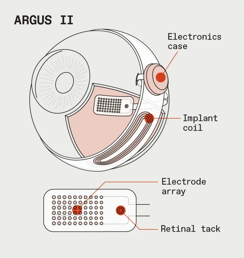  Внутреннее устройство Argus II: собственно ретинальный имплант располагается та же, где фоторецепторы натурального глаза, а на экваторе протеза размещена необходимая электронная обвязка (источник: IEEE Spectrum) 