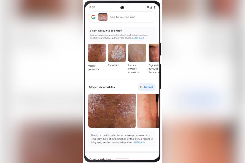 «Google Объектив» научили идентифицировать кожные заболевания