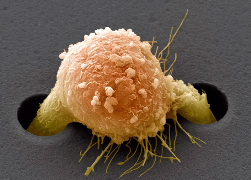  Клетка метастаз рака молочной железы. Источник изображения: Steve Gschmeissner/SPL 